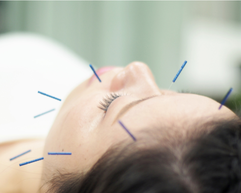 美容鍼